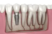Dental implant illustration showing tooth replacement procedure, Southern Style Dental, enhancing smiles with advanced dental care.